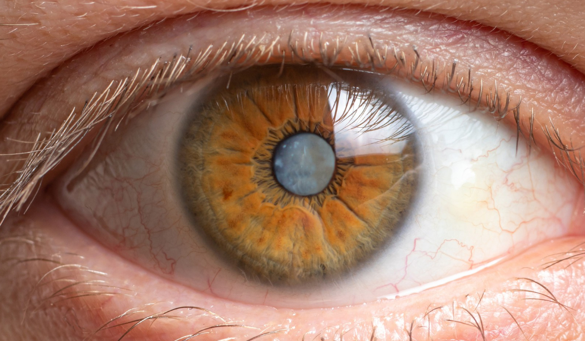 catarata en ojo humano