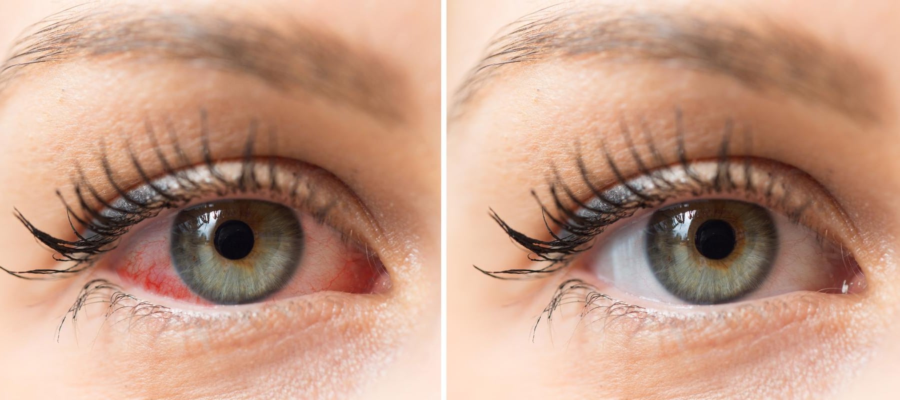 enfermedad visual conjuntivitis