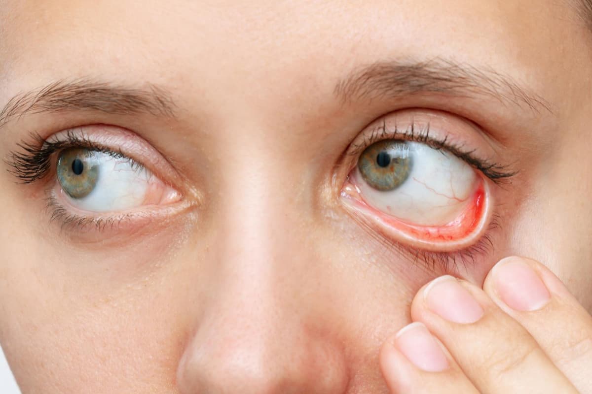 mujer con conjuntivitis