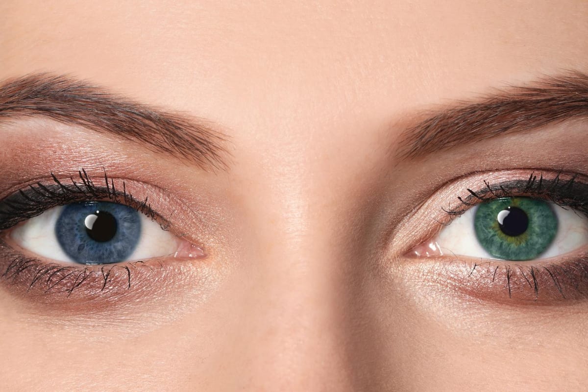 heterochromia iridis