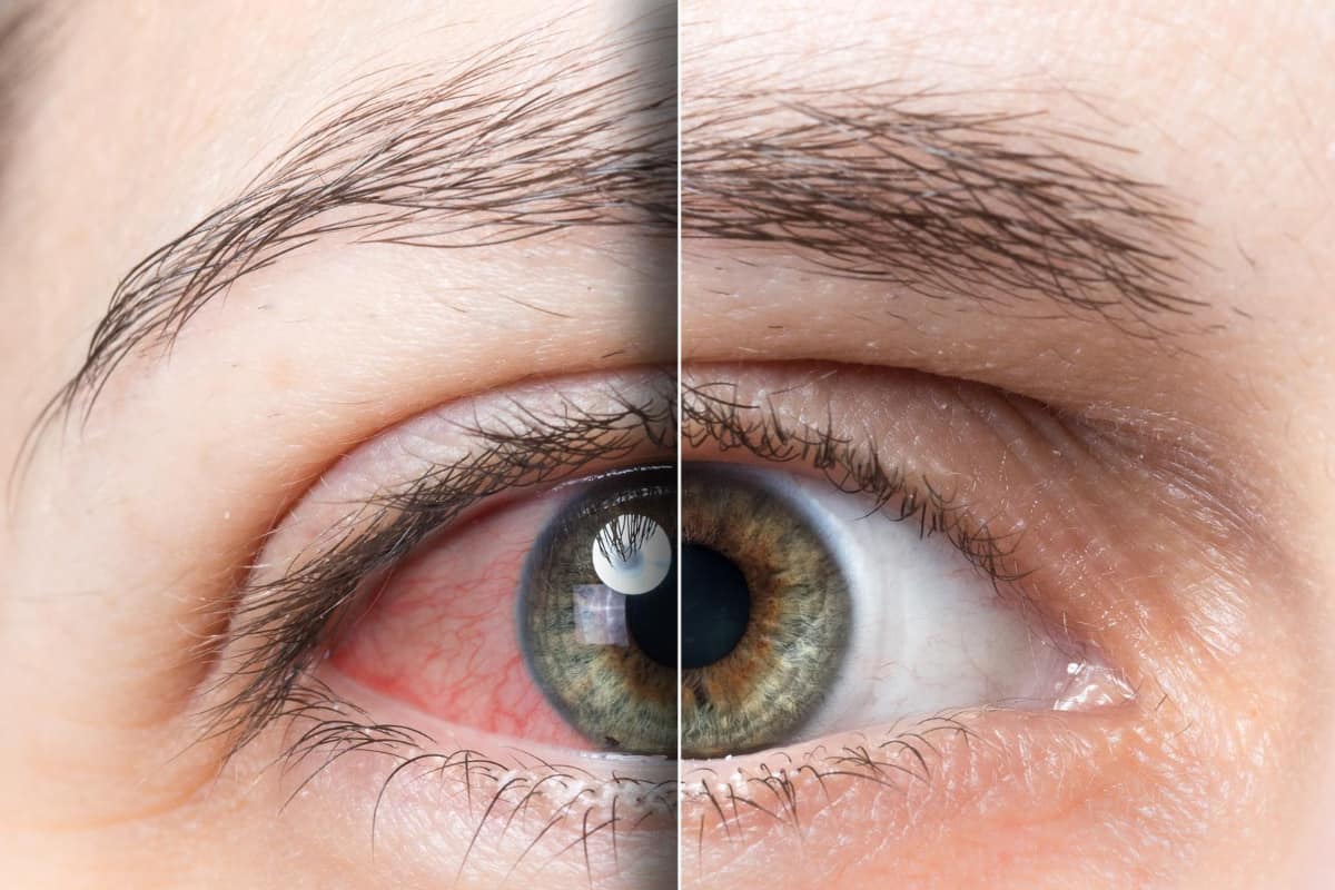 ojo con Conjuntivitis